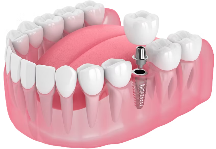 dental implants strathroy