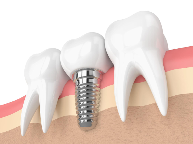 dental implants in Strathroy
