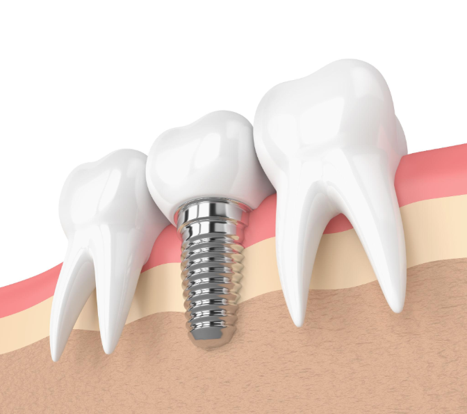 dental implants in Strathroy